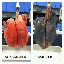 polmone sano e malato di fumo